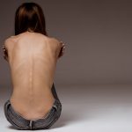 Anorexia a menštruácia